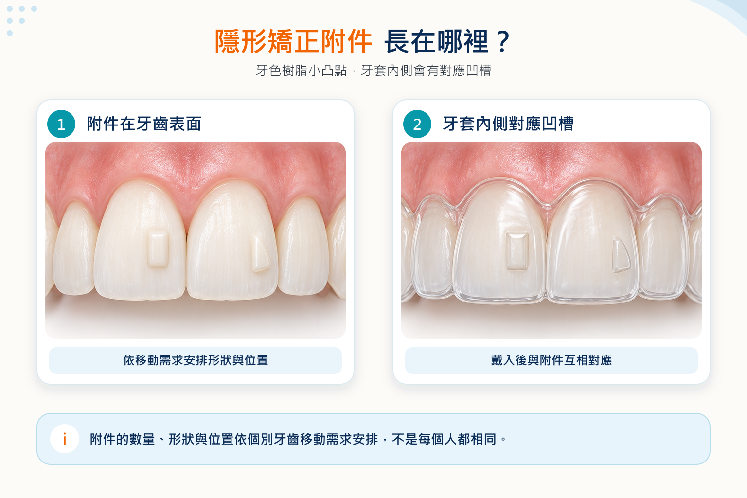 隱形矯正附件是黏在牙齒表面的牙色樹脂小凸點