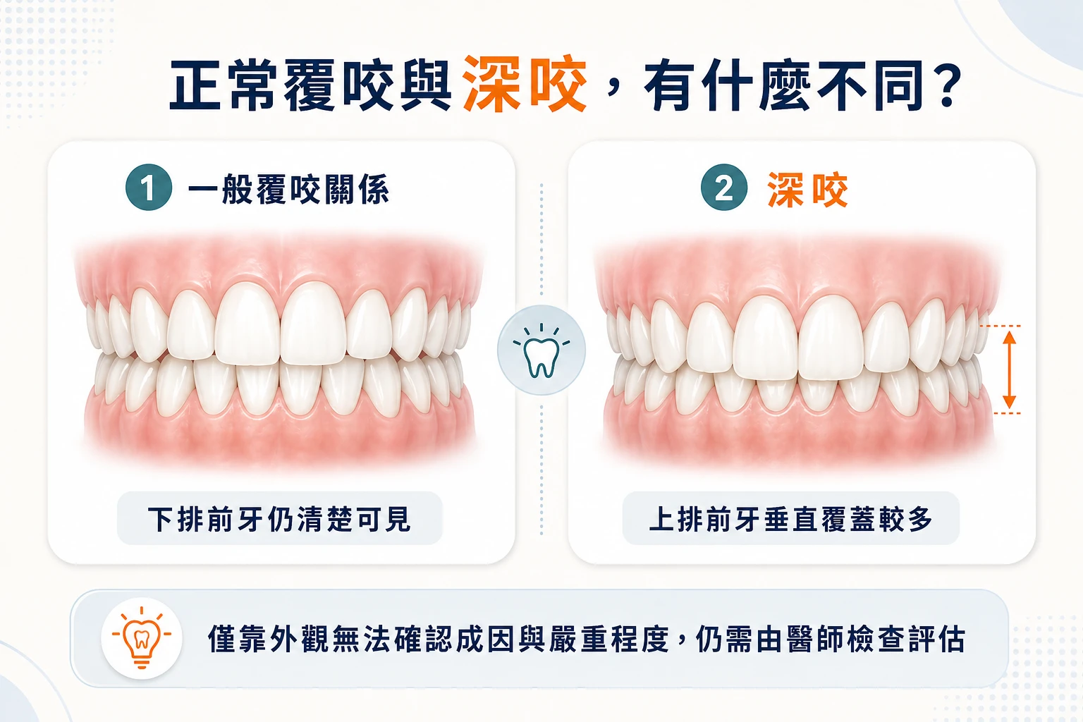 正常覆咬與深咬時上下前牙垂直覆蓋程度示意